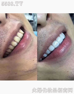 ��������Ӗ(x��n)����